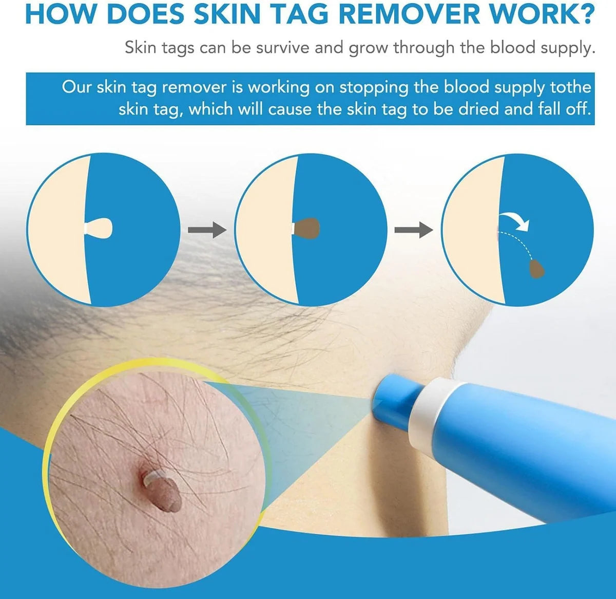Auto Skin Tag Remover